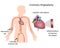 Coronary angioplasty