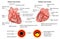 Coronary arteries and plaque formation