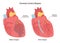 Coronary artery bypass. Damaged heart muscle, blockage of coronary artery.