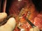 Coronary artery bypass surgery