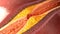 Coronary artery plaque