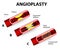 Coronary Balloon Angioplasty. Vector diagram