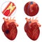 Coronary bypass. Surgery to restore blood flow in the arteries of the heart.