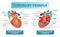 Coronary vessels anatomical health care vector illustration labeled diagram. Heart blood flow system with blood vessel scheme.