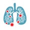 Coronavirus in China. Novel coronavirus 2019-nCoV. Virus quarantine. MERS-Cov middle East respiratory syndrome. Human lungs