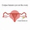 Corpus luteum cyst on the ovary. Functional . . Infographics. Vector illustration