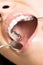 Correcting device on teeth