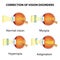 Correction of eye vision disorders by lens.