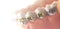 Cosmetic dental metal brackets