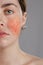 Cosmetology and rosacea. Portrait of half the face of a young woman with rosacea on her cheeks