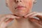 Cosmetology and rosacea. Portrait of half a woman`s face. Hands at the chin, one cheek with severe rosacea and inflammation. Clos