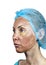 Cosmetology.Skin in the course of rejection after a deep chemical peeling. Boundary between the processed and healthy skin on a ne