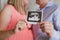 Couple looking at their baby ultrasound picture