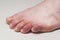 Covid toes. Coronavirus symptoms - swelling and discoloration, purplish color, pain and rough skin