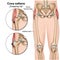 Coxa saltans syndrome 3d medical  illustration on white background