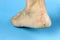 Cracked heel on blue background