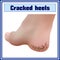 Cracked heels. Foot diseases. Dermatology.