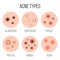 Creative illustration types of acne, pimples, skin pores, blackhead, whitehead, scar, comedone, stages diagram isolated on