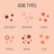 Creative illustration types of acne, pimples, skin pores, blackhead, whitehead, scar, comedone, stages diagram isolated on