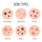 Creative vector illustration types of acne, pimples, skin pores, blackhead, whitehead, scar, comedone, stages diagram