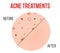 Creative vector illustration types of acne, pimples, skin pores, blackhead, whitehead, scar, comedone, stages diagram