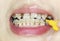 Crooked teeth with braces, interdental brushing