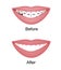 Crooked woman teeth before and after the orthodontic treatment with braces. Vector illustration isolated set