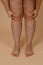 Cropped photo of woman bare naked legs, pinching fat on knees. Clipping fat folds. Body care. Fat pumping. Varicose skin
