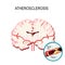 Cross section of the brain Human brain with atherosclerosis.