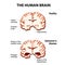 Cross-section of the human brain with Alzheimer`s disease