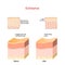 Cross-section of skin layers before and after Exfoliation