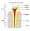 Cross section of a tooth with a crown frac