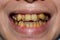 Crowded teeth with yellow stains. Poor oral hygiene