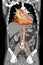 CT angiography of ABDOMINAL AORTA