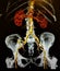 Ct angiography anterior view lumbar pelvis