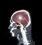 CT angiography of the brain or CTA brain  sagitta view