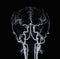 CT angiography of the brain or CTA brain showing Cerebral aryery