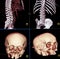 CT of body and head bones