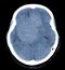 CT Brain Axial scans hyperdense mass with homogeneous, and mild perilesional brain edema at the right front-temporal-parietal