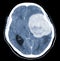 CT Brain History Headache Finding a 7 cm. extra-axial mass with stong enhancement and mass effect to left cerebral hemisphere,