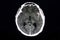 CT brain ruptured aneurysm