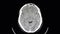 CT brain scan of a patient