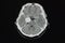 CT brain scan showing meningioma at right cavernous sinus