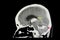 CT Brain Scan of Stroke Patient