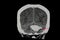 CT Brain Scan of Stroke Patient