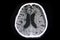 CT brain subacute subdural hematoma