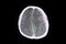 CT brain sunarachnoid hemorrhage