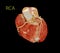 CT Cardiac 3D or CTA coronary artery