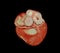 CT Cardiac 3D or CTA coronary artery