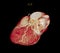 CT Cardiac 3D or CTA coronary artery